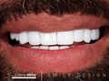 Smile Design Dra. Lorena Soto😃  @dra.lorenasotob Aesthetic dentistry  🛩 🇺🇸🇨🇴   schedule your assessment appointment Contáctanos @dra.lorenasotob  WhatsApp: +57 314 547 3898 . . #diseñodesonrisa #cosmeticdentistry #smile #smiledesingn #esteticadental #porceinervenveners #steticdentistry #diseñodesonrisa #mexico #miamiflorida #newyork #canada #republicadominicana #santodomingo #smiledesingn  #expertaensonrisas #georgia #atlanta