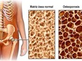 #Osteoporosis La #osteoporosis es una falta de masa y densidad ósea con destrucción de la microarquitectura y un mayor riesgo de #fracturas. La #osteodensitometría se utiliza para su diagnóstico. Además del tratamiento con #bifosfatos, #calcio y #vitaminaD, la #nutrición y las actividades físicas son pilares terapéu importantes. Muchos pacientes con #osteoporosis se quejan de dolores óseos difusos. Estos pueden ser tratados positivamente con la administración de #CBD, posiblemente de forma aditiva. El deseo de una terapia natural se expresa muy a menudo, ya que normalmente hay que tomar varios medicamentos.