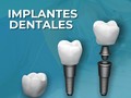 Los implantes dentales son la mejor opción para restaurar una pérdida dental🦷   Los lmplantes dentales estan formados por una estructura de titanio, similar a un tornillo, cuya finalidad es sustituir una pieza dental ausente y también como soporte de una prótesis dental   Tú sonrisa es nuestra prioridad😁 Contáctanos al 📲 04126299571 para mayor información  #implantesdentales #odontopediatria #endodontist #venezuela #caracas #clinicadental #odontologiaestetica #ortodoncia #saludbucal #cariesdental #limpiezadental #cepillodedientes #cuidadodental