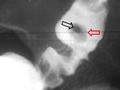 La diverticulitis es la inflamación y/o una infección de un divertículo, que puede causar un flemón de la pared intestinal, peritonitis, perforación, fístula o absceso. El síntoma principal es el dolor abdominal. El diagnóstico se efectúa por TC. El tratamiento se basa en reposo intestinal, a veces antibió y, en algunos casos, Los pacientes suelen presentar cuadros clínicos clásicos con dolor en fosa iliaca izquierda, fiebre y aumento de la concentración de las células blancas en la sangre. También pueden presentar diarrea, náuseas y sangrado rectal.  Se reconoce por el signo de blumberg en FID O mal llamada apendicitis derecha ...